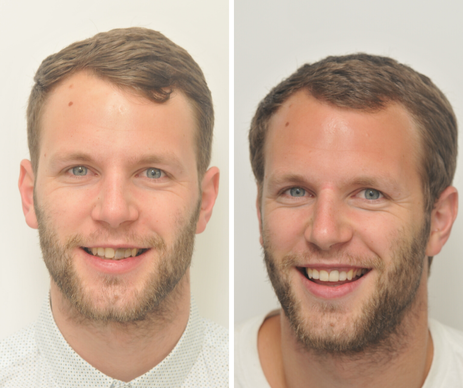 Root canal treatment - Finn Dental Specialists