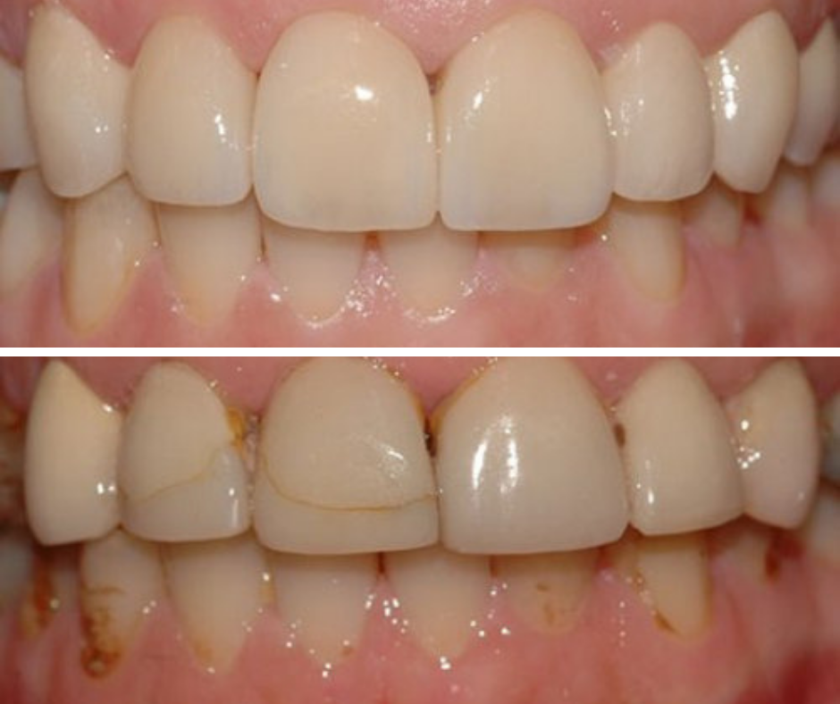 Living with veneers Finn Dental Specialists